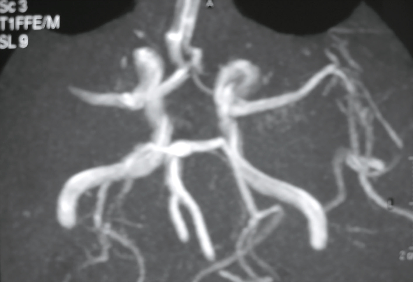 L'image montre une angiographie cérébrale, visualisant les vaisseaux sanguins du cerveau. Elle aide à détecter des anomalies vasculaires comme les anévrismes et planifier les traitements.