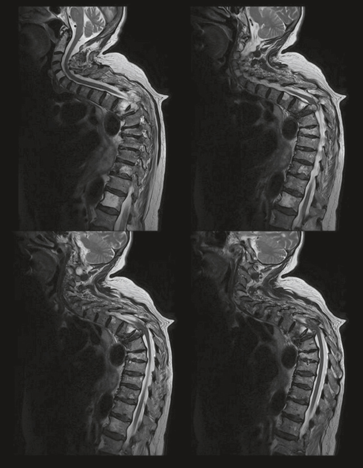 IRM sagittale de la moelle cervicale et dorsale montrant un hypersignal intramédullaire, suggérant une souffrance médullaire sans lésion osseuse évidente.