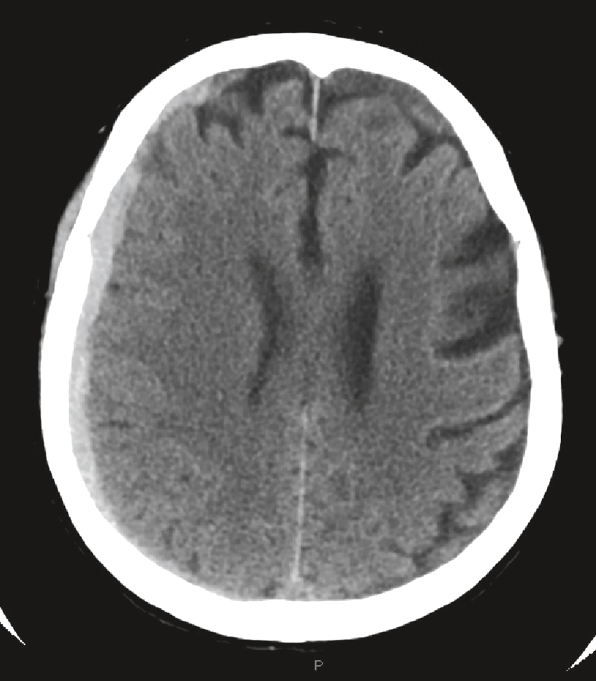 Scanner montrant un infarctus ischémique massif à gauche avec œdème diffus et perte de différenciation cortico-sous-corticale, sans signe d’engagement immédiat.