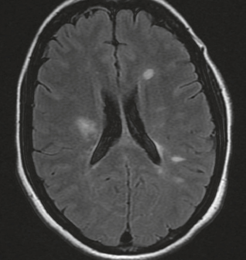 IRM FLAIR révélant des lésions multiples périventriculaires évoquant une pathologie démyélinisante comme la sclérose en plaques.