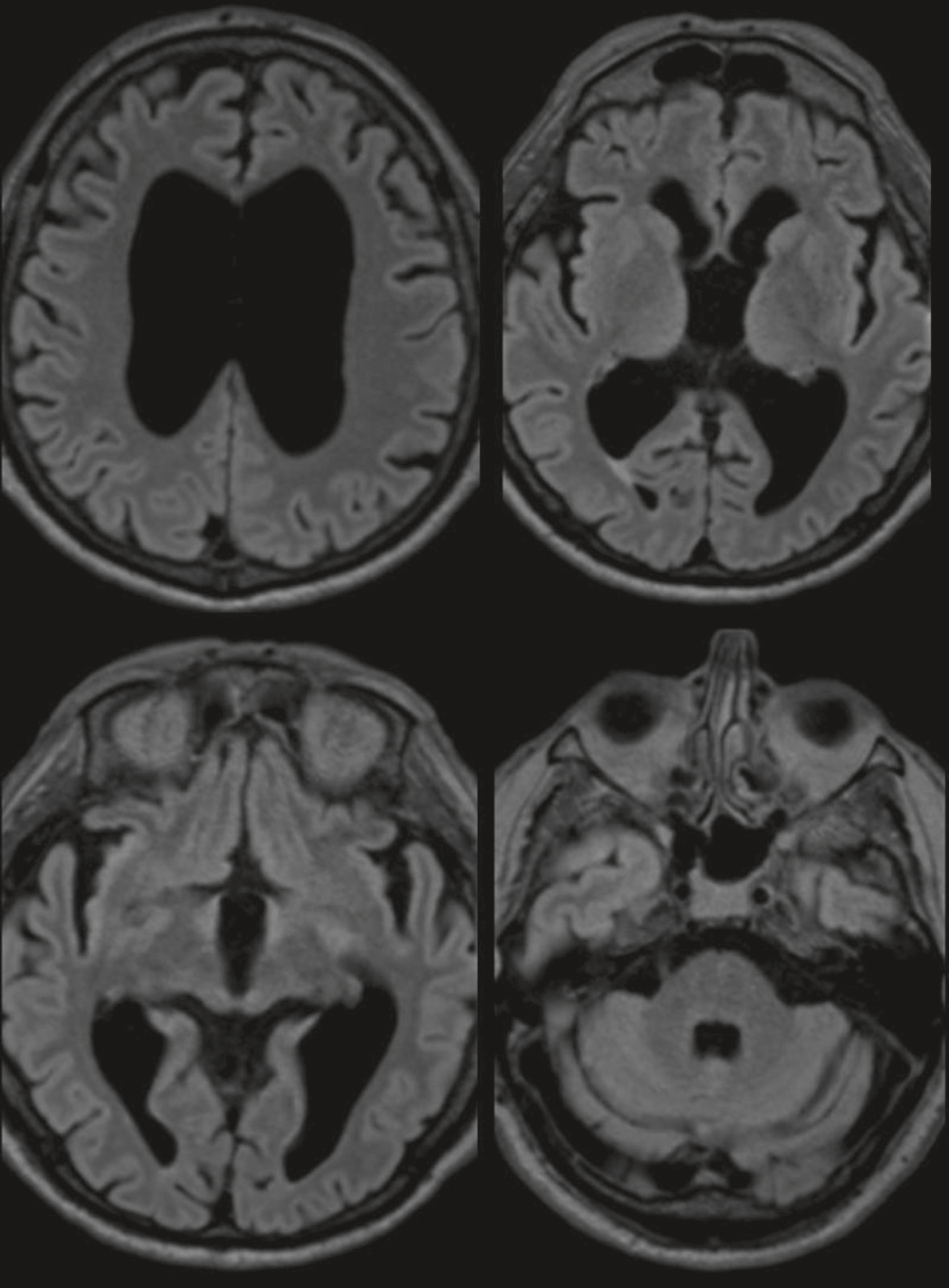 IRM FLAIR montrant une atrophie cérébrale diffuse avec dilatation ventriculaire. Aspect évocateur d’un processus neurodégénératif avancé.