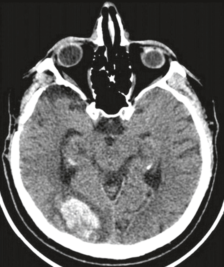 Scanner cérébral montrant une hémorragie temporale gauche avec effet de masse et compression des structures adjacentes, sans extension ventriculaire visible.