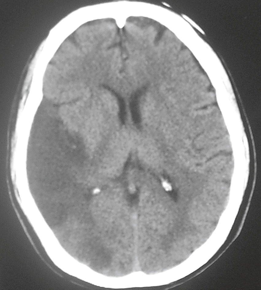 Scanner montrant un hématome lenticulaire gauche avec effet de masse modéré, sans extension ventriculaire, évoquant une hémorragie hypertensive profonde.