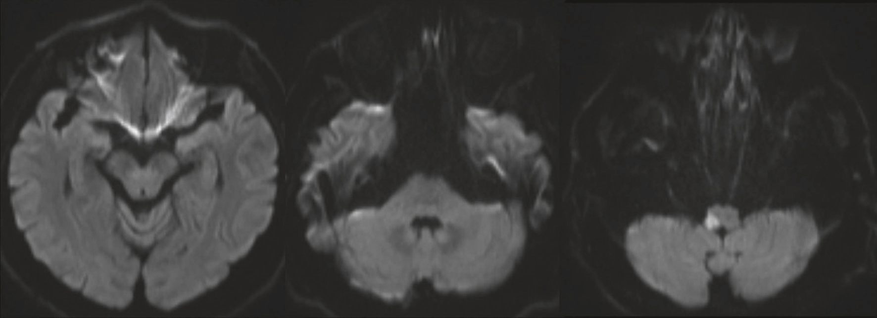 IRM en diffusion montrant ischémies aiguës multiples dans le territoire vertébro-basilaire postérieur.