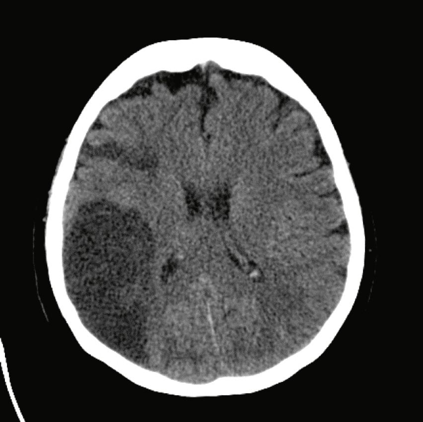 Scanner montrant un hématome temporal gauche avec œdème localisé. Effet de masse discret et légère déviation de la ligne médiane.