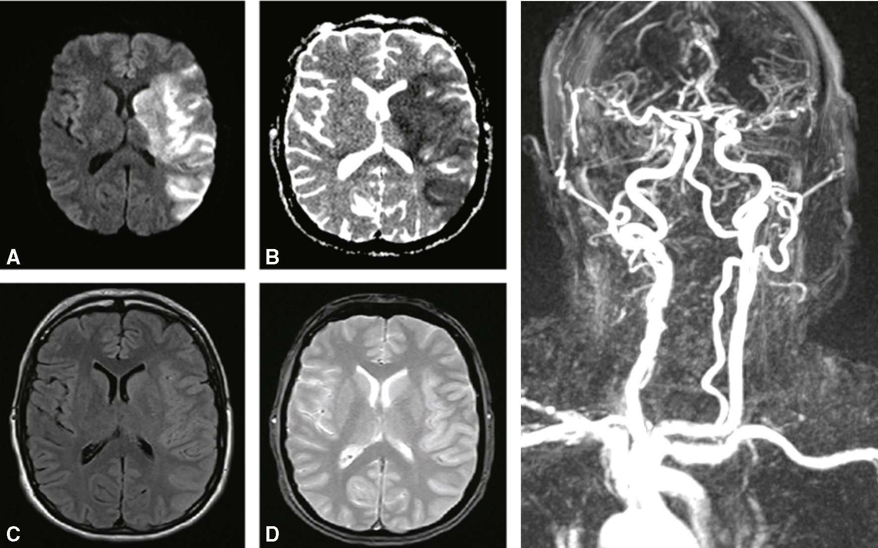 IRM multimodale montrant un AVC ischémique gauche aigu avec restriction de diffusion et réduction du flux artériel.