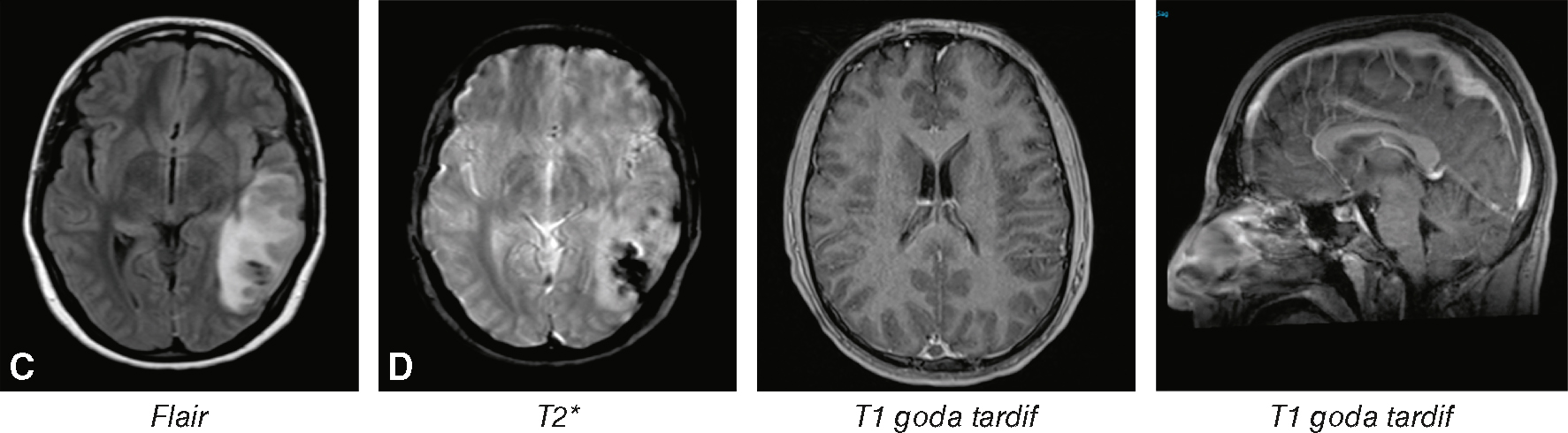 L'IRM montre 4 coupes (FLAIR, T2, T1 gado tardif axial et sagittal), illustrant les lésions cérébrales, microhémorragies et anomalies structurelles post-gadolinium.